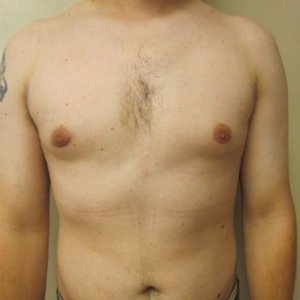 manhattan gynecomastia surgery after 5